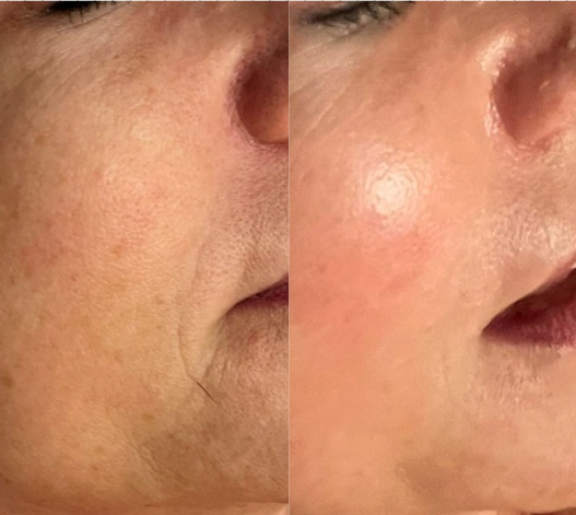 Dr. Platon Cold Plasma skin rejuvenation treatment
