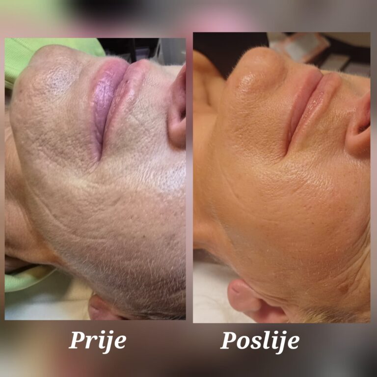 Dr. Platon Cold Plasma skin rejuvenation