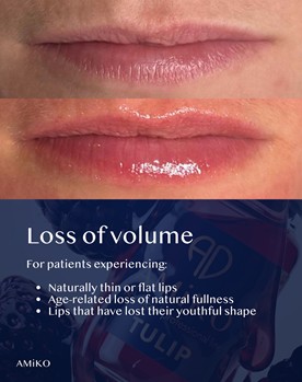 Amiko Tulip can help with loss of volume in the lips